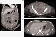 Spontaneous ovarian hyperstimulation syndrome mimicking ovarian cancer in a nonpregnant woman: A case report and literature review