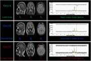 Neurochemical Alterations Linked to Persistent COVID 19 Induced Anosmia: Probing Into Orbitofrontal Cortex by Magnetic Resonance Spectroscopy