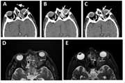 CT Scan Guided Intra-orbital Amphotericin Injection in COVID19 associated Mucormycosis, a pilot study