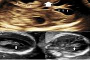 Fetal intracranial hemorrhage and infarct: Main sonographic and MRI characteristics: A review article