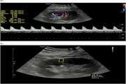 Combination of Doppler US and US Elastography is Superior to Doppler US or US Elastography Alone in Detecting Delayed Kidney Graft Rejection