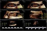 Evaluation and Predictive Value of Placental Thickness in Fetal Biometric Assessment and Doppler Indices of the Uterine and Umbilical Arteries Original Article