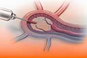 Arterial Embolization for the Internal Hemorrhoids Management A Systematic Review