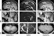 The evolving role of MR black-blood thrombus imaging in the diagnosis of cerebral venous thrombosis