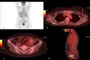 No Restriction on DWI and Low Uptake in PET CT in a Genital Metastasis from Breast Lobular Cancer