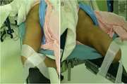 Extracorporeal shock wave therapy (ESWT) for treatment of osteonecrosis of the femoral head: a systematic review and meta-analysis