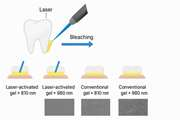Efficacy of diode laser irradiation during dental bleaching in preventing enamel damage caused by bleaching