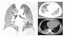 Chest CT scan features to predict COVID-19