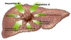 ((CT,MRI) پیش از پیوند و عود پس از پیوند در hepatocellular carci