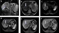 Apparent Diffusion Coefficient MRI in Hepatocellular Adenoma
