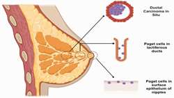 Mammary Paget’s Disease Mimicking Benign and Malignant Dermatolo