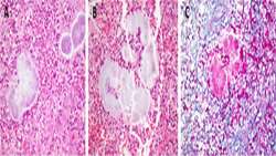 Primary Actinomyces in Hand
