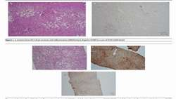 Immunohistochemical Subtypes of Hepatocellular Adenomas in Irani
