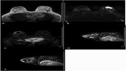 MRI Value in BIRADS-3 Masses for ART Candidates