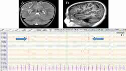 Agreement between EEG and MRI in pediatric seizure monitoring
