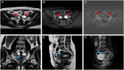 Refining MRI protocols for endometriosis