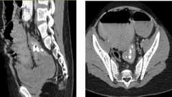Pediatric inflammatory myofibroblastic tumor at rectosigmoid jun