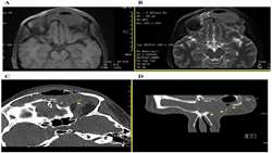 Endoscopic sinus surgery for Pott’s tumor in pregnancy