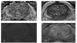 Diagnostic Value of mp-MRI vs. TRUS Biopsy in PCa
