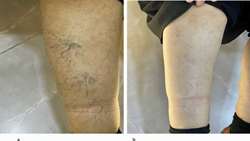 Chronic Venous Disease After Intra-arterial Stem Cell Injection