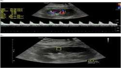 Doppler US and US Elastography is Superior to Doppler US or US