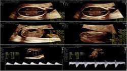 Placental Thickness in Fetal Biometric Assessment and Doppler In