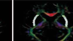 Age-dependent brain subcortical white and gray matter disruption