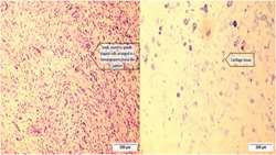 Expanded intravenous mesenchymal chondrosarcoma with  thrombosis