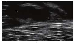 Sonographic in Breast Invasive Ductal Carcinoma