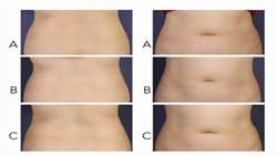Efficacy and Safety of Deoxycholic Acid Injection in Reduction o