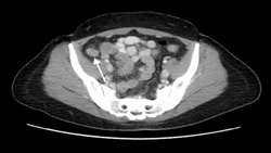 Imaging Findings in Symptomatic Appendiceal Endometriosis