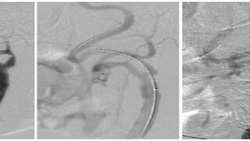 Efficacy of Carotid Artery Stenting Without Embolic Protection 