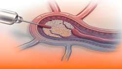 Arterial Embolization for the Internal Hemorrhoids Management