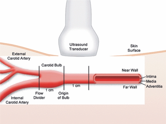  subclinical atherosclerosis  {faces}