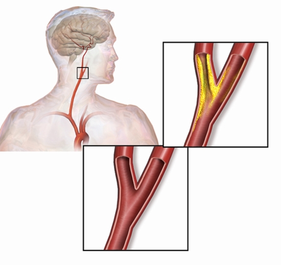 carotid advanced atherosclerotic stenosis  {faces}