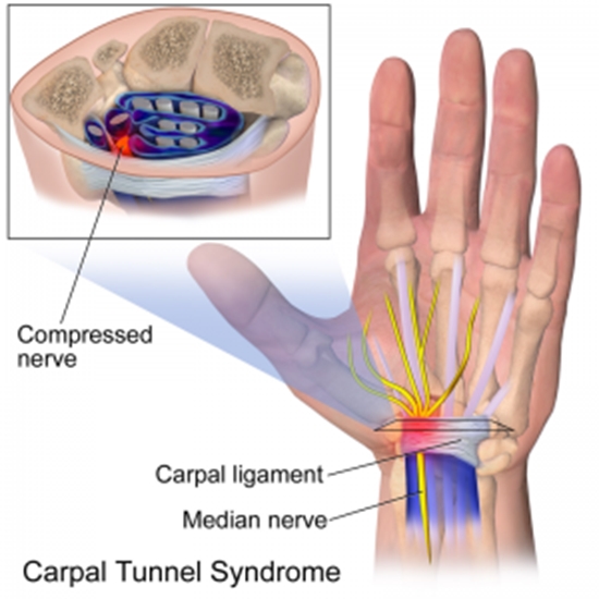 Diagnosing Carpal Tunnel Syndrome and Determining Its Severity {faces}