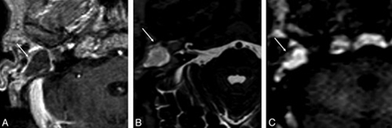 MRI sequences in cholesteatoma  {faces}