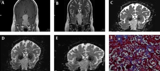 Tumor in Pituitary Macroadenomas & Preoperative Diffusion (ADC) Map {faces}