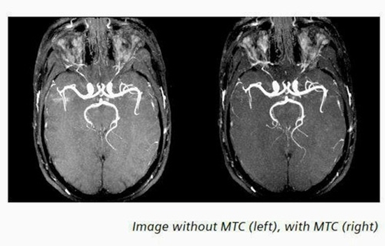 تکنیک 3D–TOF MRAبا و بدون تزریق ماده حاجب وانژیوگرافی DSA درانوریسم مغزی  
