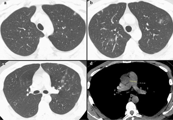 همبستگی بین دیامتر تنه شریان ریوی درct و شدت هیپرتانسیون آن در اکوکاردیوگرافی  
