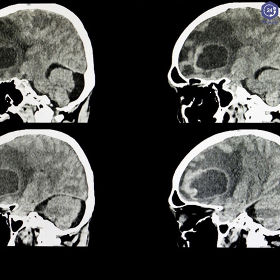   MRI پرفیوژن در درج بندی تومورهای گلیال مغز  