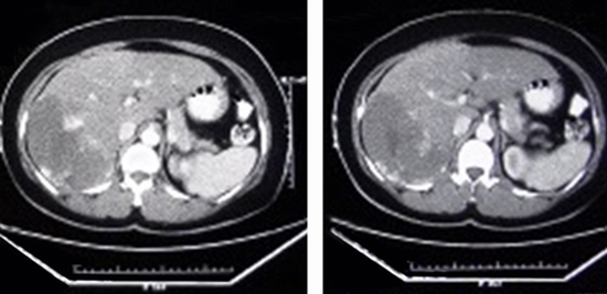 Management of Liver Hemangioma {faces}