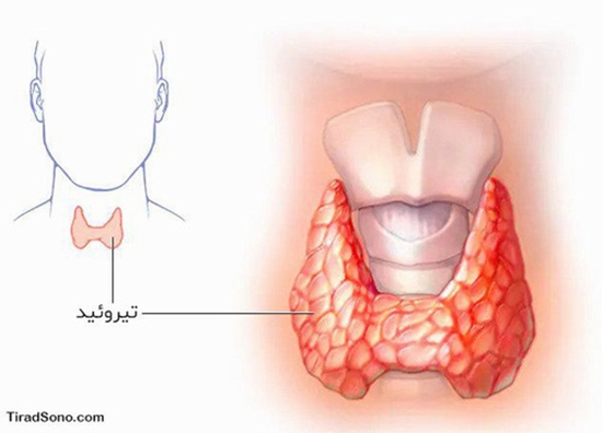 ندول تیرویید 