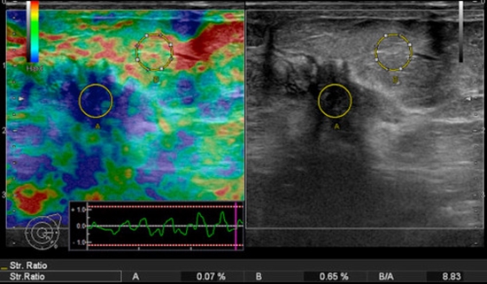 sonoelastography of breast {faces}