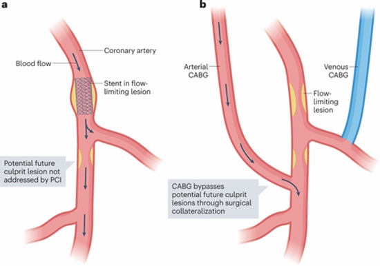 Coronary Artery Stenosis {faces}