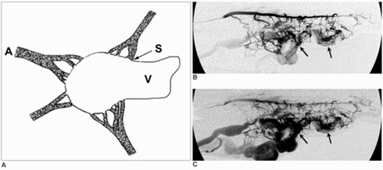 Peripheral Venous Malformations with a Dominant Outflow Vein {faces}