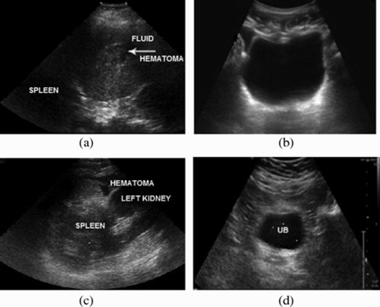 Secondary Ultrasound Exam in Blunt Abdominal Trauma {faces}