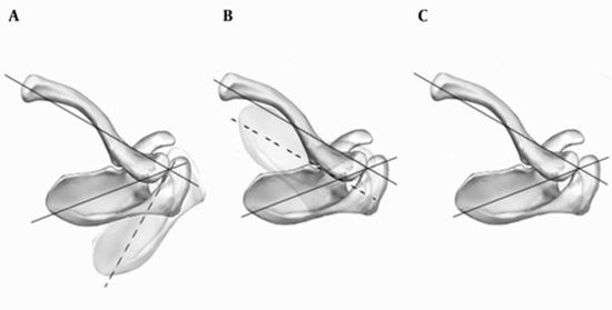 Dynamic Comparison of Segmentary Scapulohumeral Rhythm {faces}