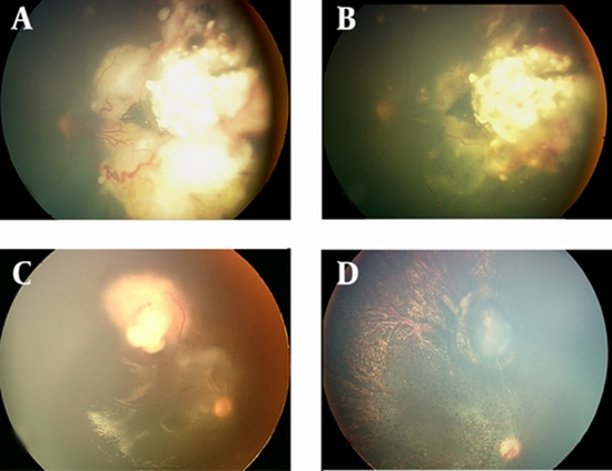 Outcome of Retinoblastoma  {faces}