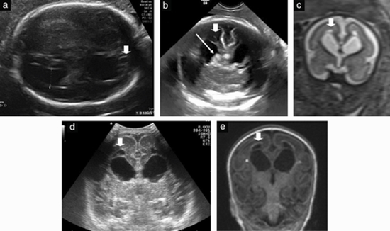 Fetal intraventricular hemorrhage {faces}